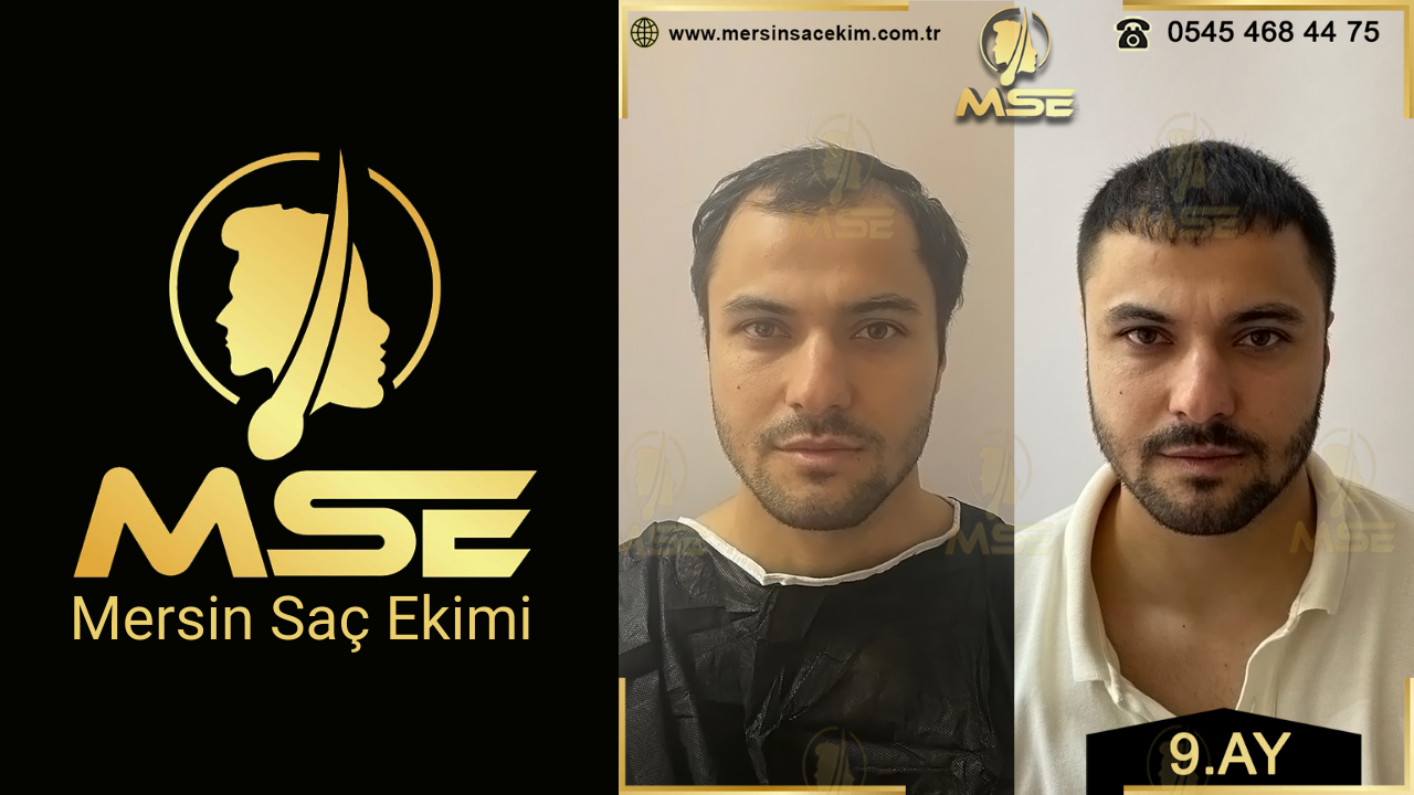 Mersin Saç Ekimi